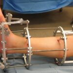 Exploring The Life-Changing Effects Of Cosmetic Limb Lengthening