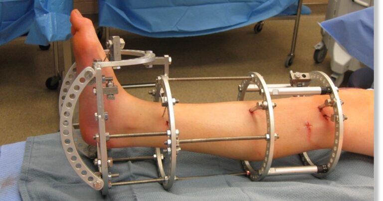 Exploring The Life-Changing Effects Of Cosmetic Limb Lengthening